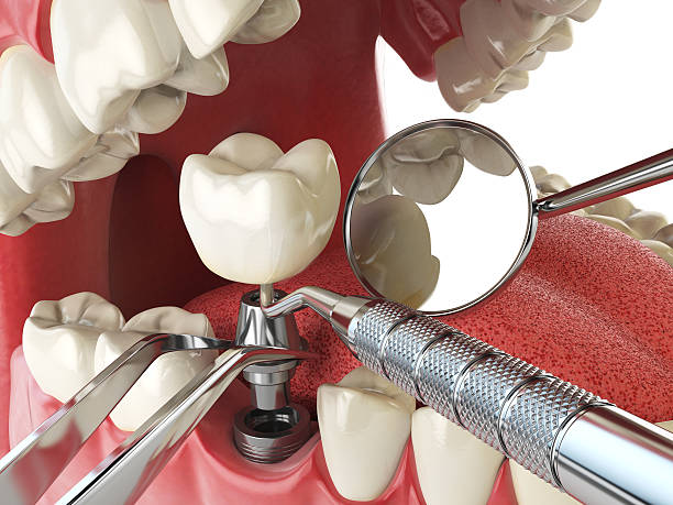 Best Emergency Dental Care for Broken or Chipped Teeth in Dover, DE